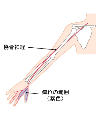 上肢（腕、手）の末梢神経障害 | 上石神井もりもと脳神経外科