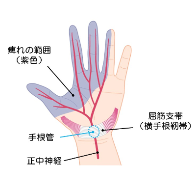 上肢（腕、手）の末梢神経障害 | 上石神井もりもと脳神経外科