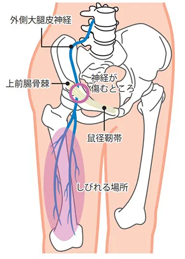 下肢（あし）の末梢神経障害 | 上石神井もりもと脳神経外科