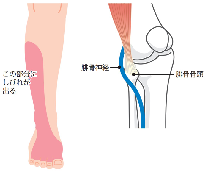 下肢（あし）の末梢神経障害 | 上石神井もりもと脳神経外科